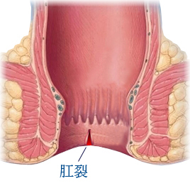 香港痔瘡專科_甚麼是肛裂